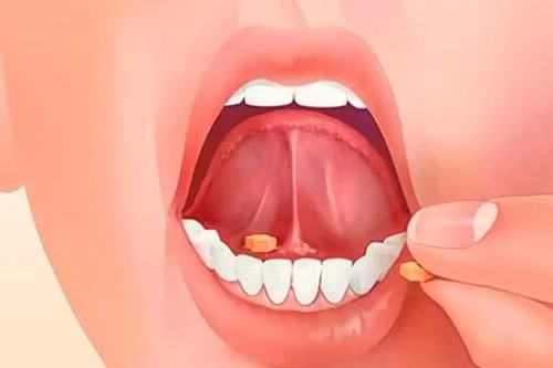 Tratamiento sublingual con misotrol